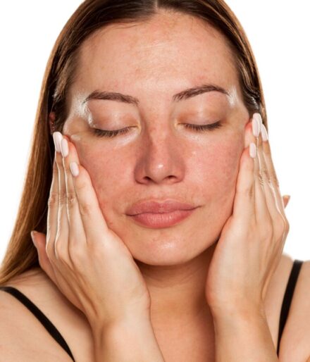 Le mélasma (Chloasma)