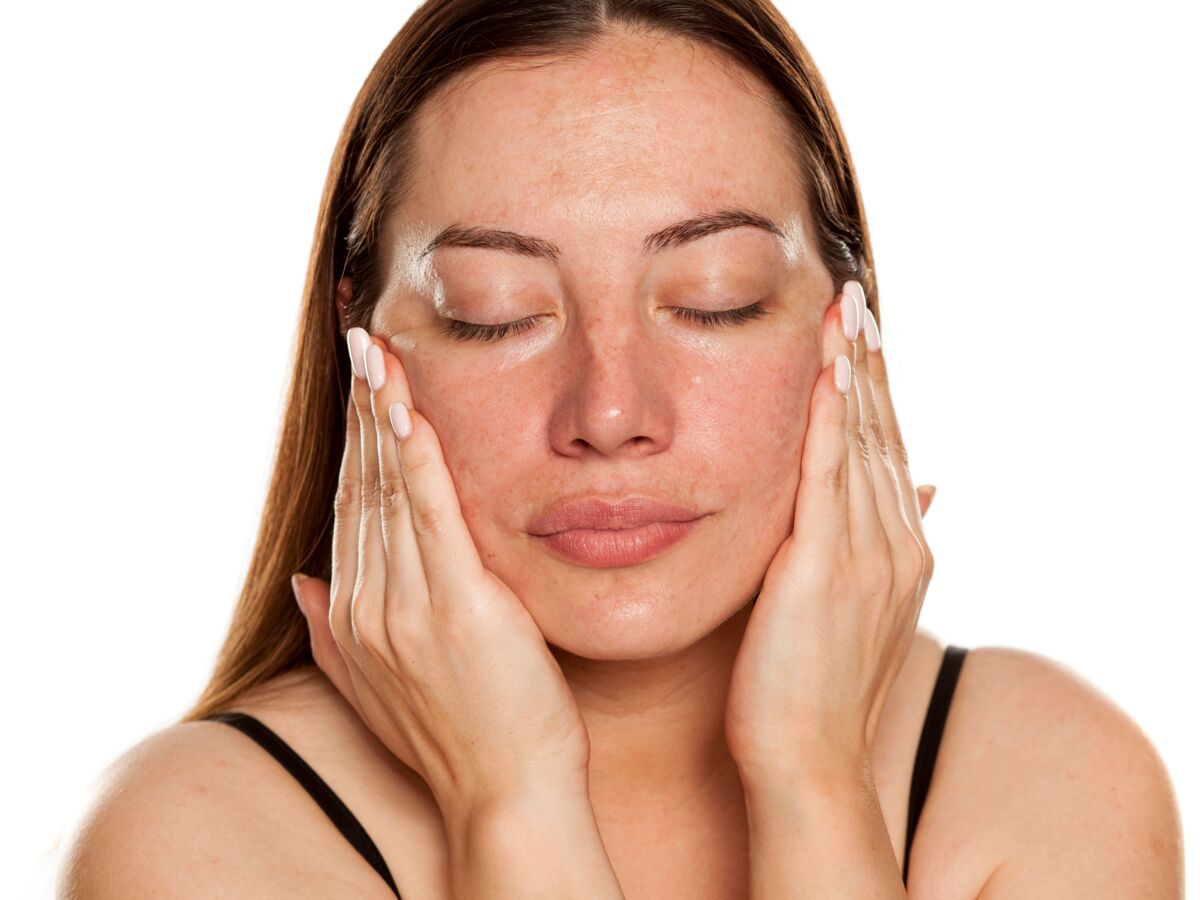 Le mélasma (Chloasma)